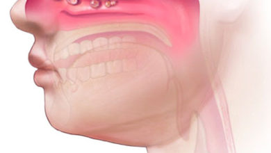 Burun polibi / nazal polip 5