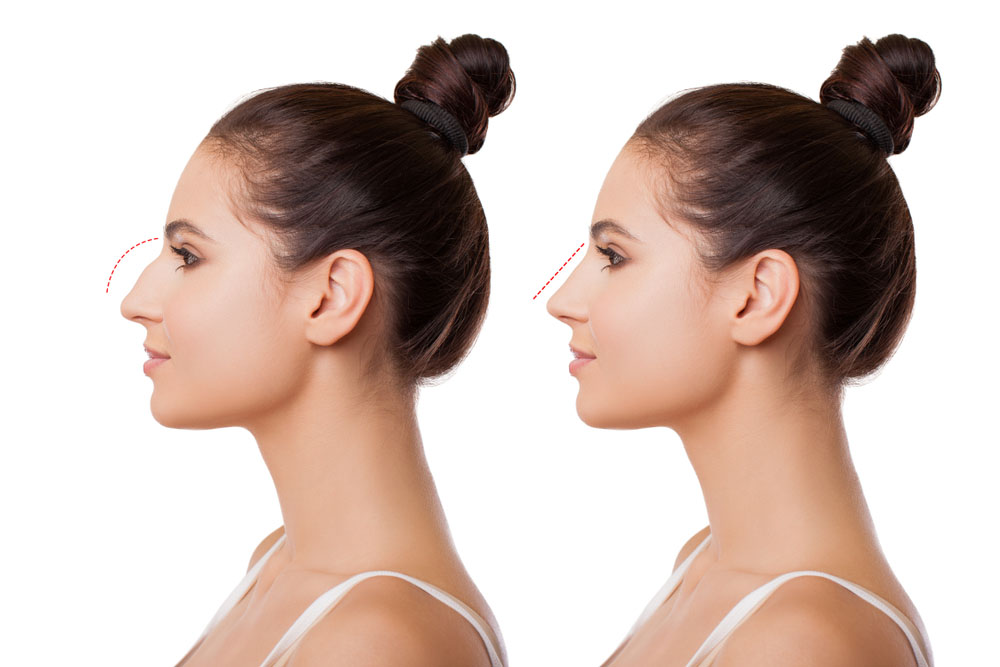 Burun törpüleme nedir? — haber görseli