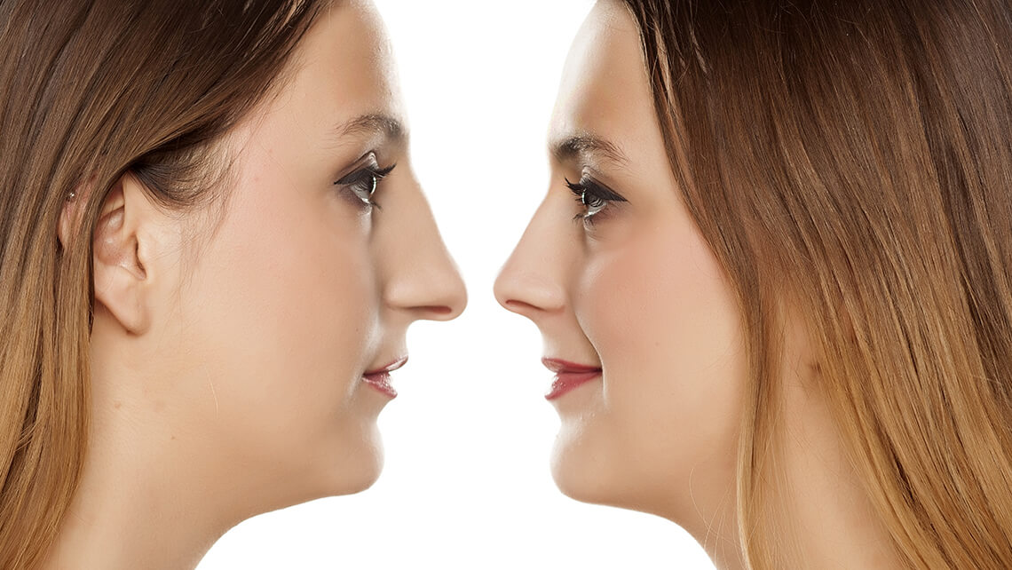 Burun ucu estetiği nasıl olmalıdır? 7