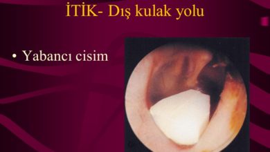 Dış kulak yolunda yabancı cisim 1