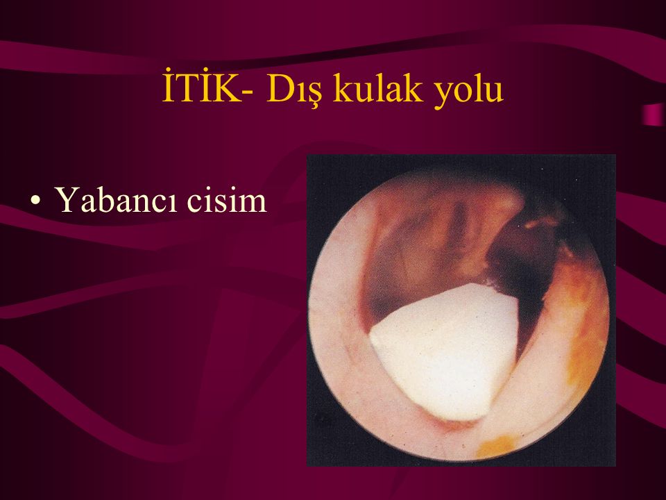 Dış kulak yolunda yabancı cisim — haber görseli