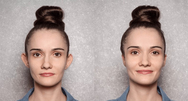 Kepçe kulak estetiği nedir? 7