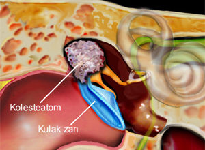 Kolesteatom : ciddi bir kulak sorunu 1