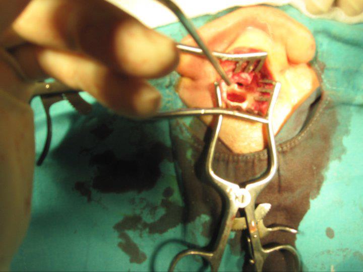 Kulak mikrocerrahisi 7