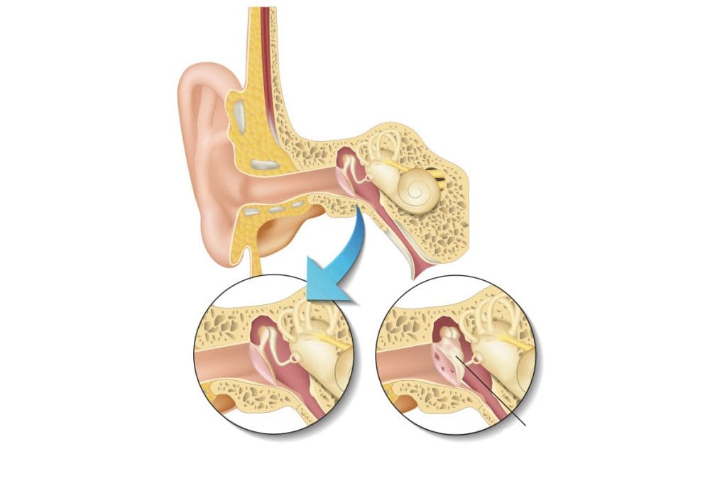 Kulak zarı ameliyatı - timpanoplasti nedir? 7