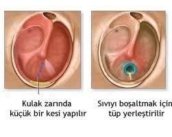 Kulak zarına tüp takılması 8