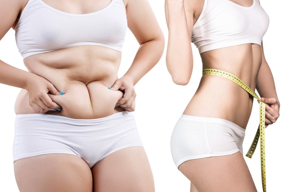 Liposuction ( yağ alma/ yağ çekme) işlemi ve sonrası — haber görseli