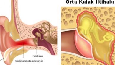 Orta kulak iltihapları (kronik) 3