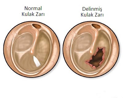 Orta kulak yapılarında uygulanan kulak zarı yırtığı: timpanoplasti! 7