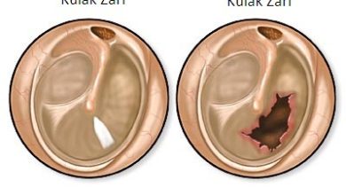 Orta kulak yapılarında uygulanan kulak zarı yırtığı: timpanoplasti! 1