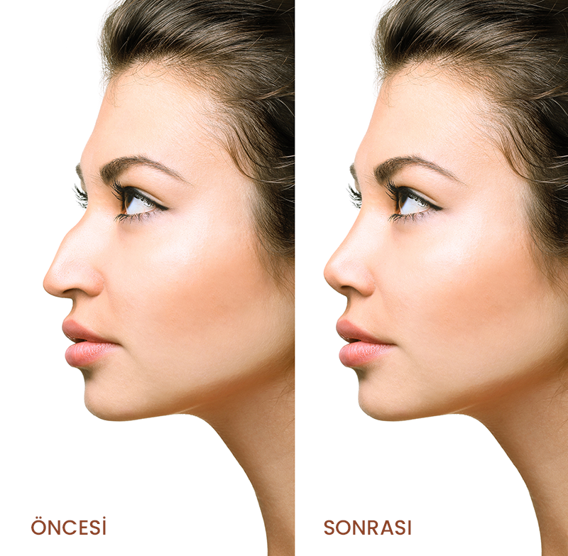 Rinoplasti (burun estetiği) nedir ? 7