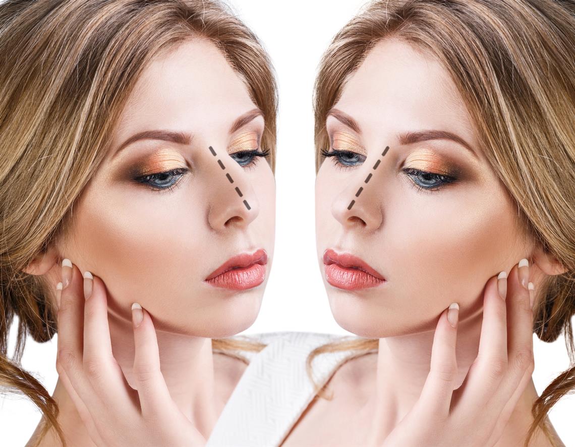 Rinoplasti, septorinoplasti, burun estetik ameliyatı nedir? 7