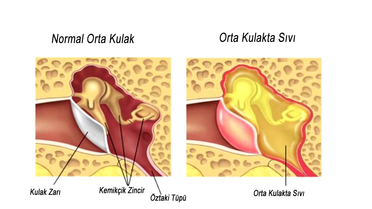 "seröz otitis media" kulakta sıvı birikmesi — haber görseli