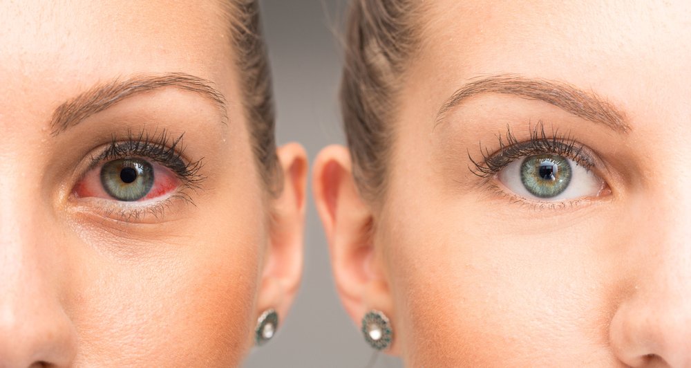 Üveit nedir? Tedavisi nasıldır? — haber görseli