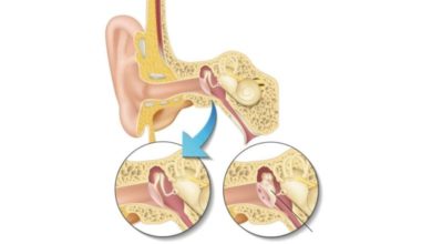 Timpanoplasti – miringoplasti (kulak zarı deliği – kronik otit ameliyatı) 1