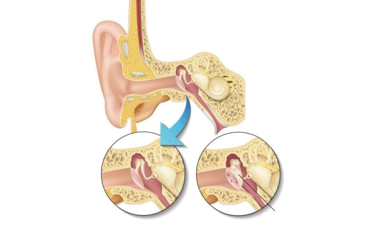 Timpanoplasti – miringoplasti (kulak zarı deliği – kronik otit ameliyatı) 7