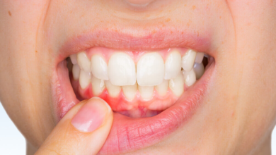 Dişlerin Sallanmasının Nedenleri Nedir ? Sallanan Dişler Nasıl tedavi Edilir? 1