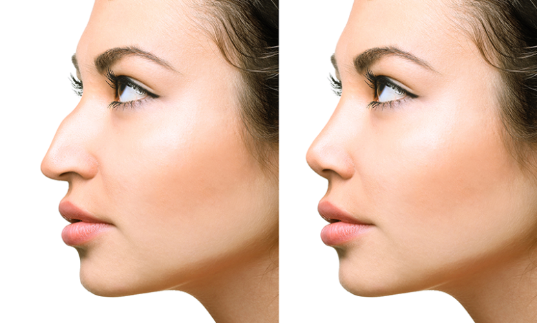 Burun estetiği – rinoplasti 7