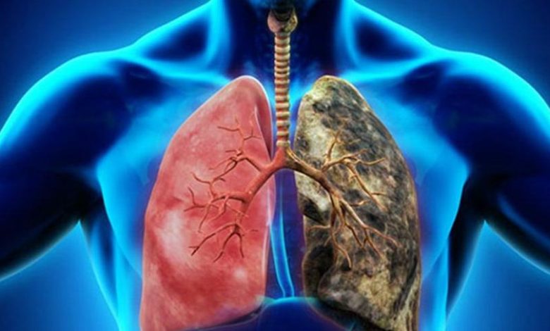 Akciğer kanseri hakkında bilmeniz gerekenler 7
