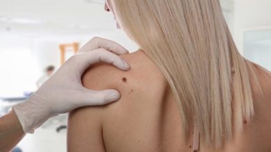 Renkli ve şekil değiştiren benler cilt kanserine işaret edebilir 1