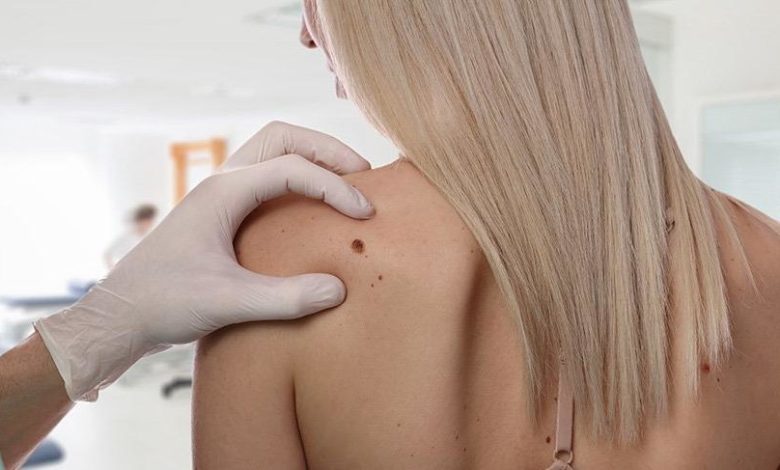 Renkli ve şekil değiştiren benler cilt kanserine işaret edebilir 7