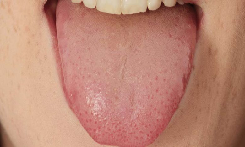 Ağız ve dil kanserleri 1