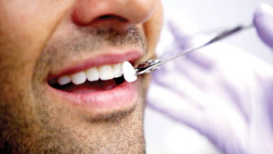 Lamine Veneer Nedir? 15