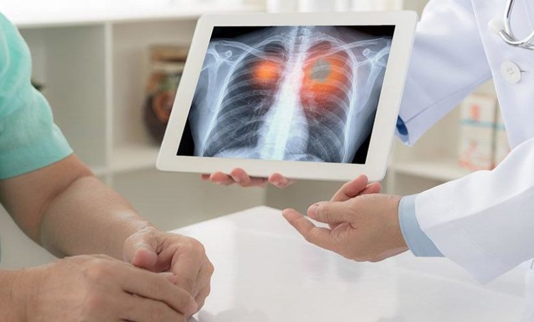 Akciğer kanseri tanı ve tedavisine yaklaşım 7