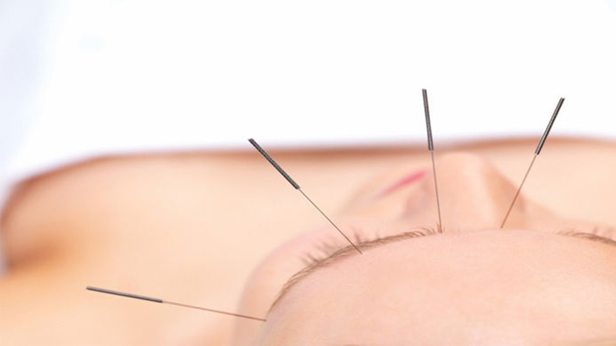 Migren tedavisinde akupunktur nasıl etkilidir? 6