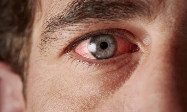 Göz İçi Tümörlerde Oluşan Belirtiler 7