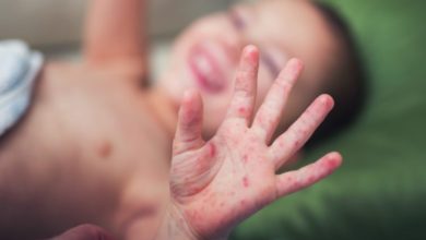 Çocukluk Çağı Sık Rastlanılan Dermatolojik Hastalıklar ve Tedavi Seçenekleri 5