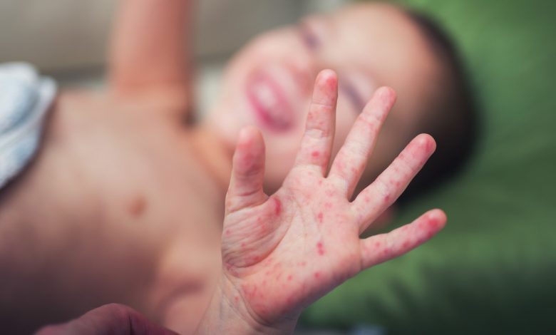 Çocukluk Çağı Sık Rastlanılan Dermatolojik Hastalıklar ve Tedavi Seçenekleri 1