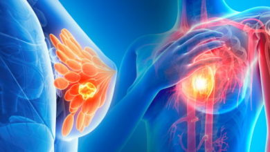 Meme Kanseri İçin Risk Faktörleri 1