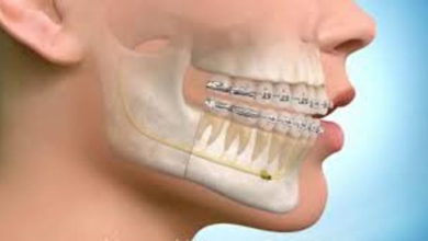 Ortodontik Tedavi Sonrası Dişlerim Eski Haline Döner Mi? 1