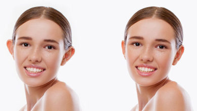 Kepçe Kulak Estetiği (Otoplasti) 1