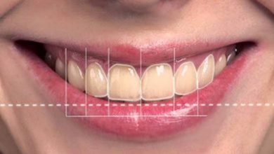 Gülüş Tasarımı Nasıl Yapılır? 1