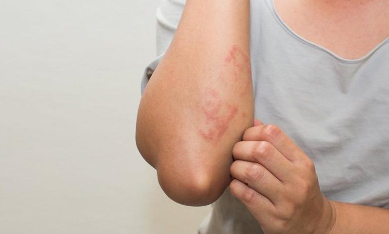 Ürtiker (Kurdeşen) 7