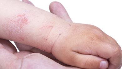 Atopik Dermatit – Çocukluk Çağı Egzeması 1