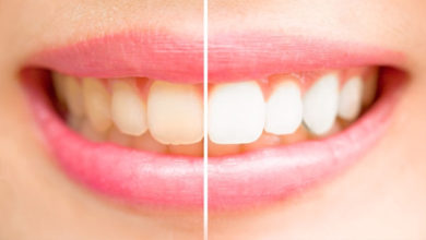 Diş Renklenmeleri ve Beyazlatma 5