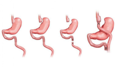 Gastrik By-Pass Uygulaması 3