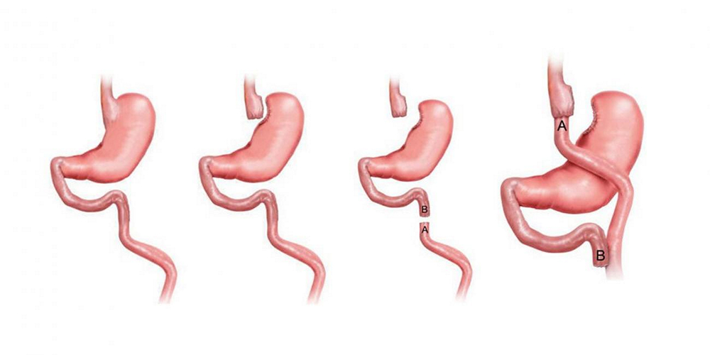 Gastrik By-Pass Uygulaması 7