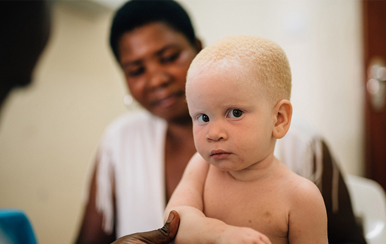Albinizm Farkındalık Günü'nde “Beyaz Melekler”e destek olun 6