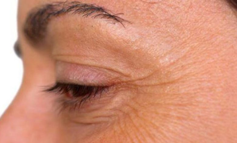 Vücuttaki kırışıklıklara dikkat ! 1