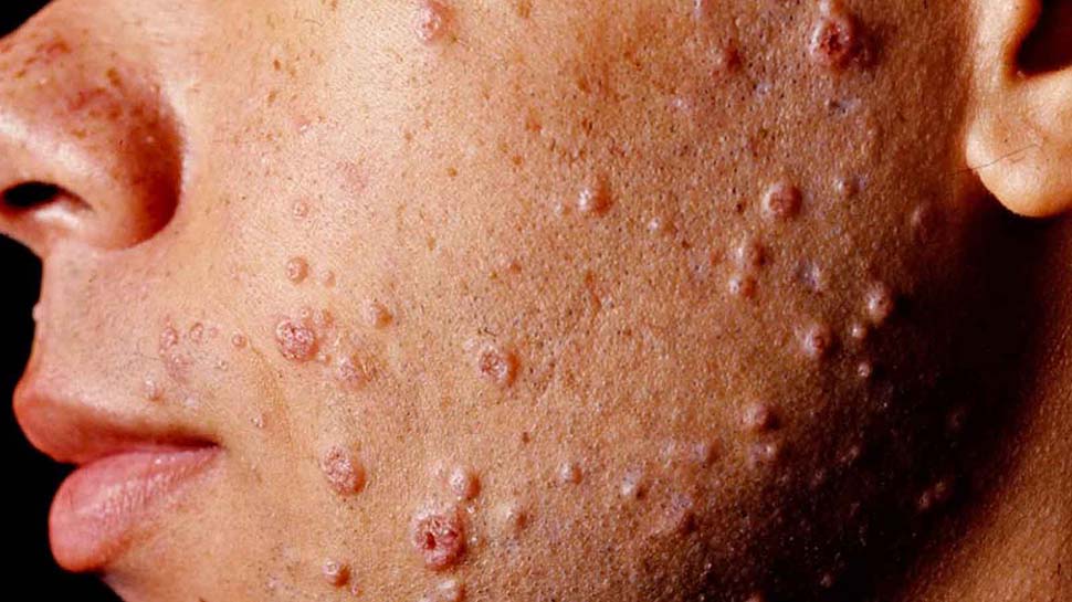 Molluskum Kontagiozum Nedir? 7