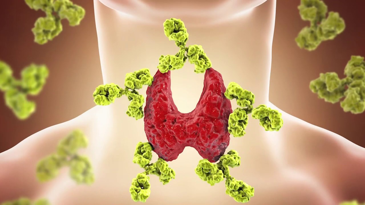 Haşimato tiroidi nedir? 6