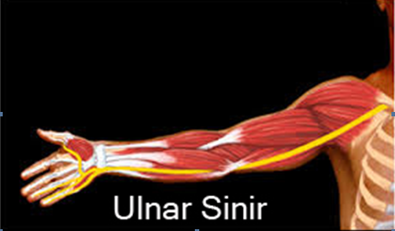 Dirsekte Sinir Sıkışması ( Ulnar Oluk Sendromu ) 3
