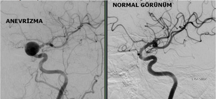 Beyin anevrizmaları 3