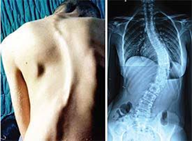 Skolyoz ( Omurga eğriliği ) 3