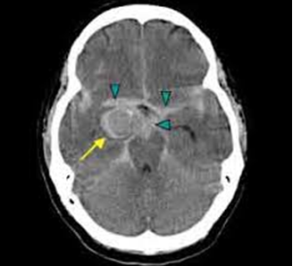 Beyin anevrizmaları 5