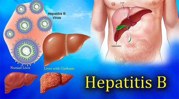 Hepatit B 4
